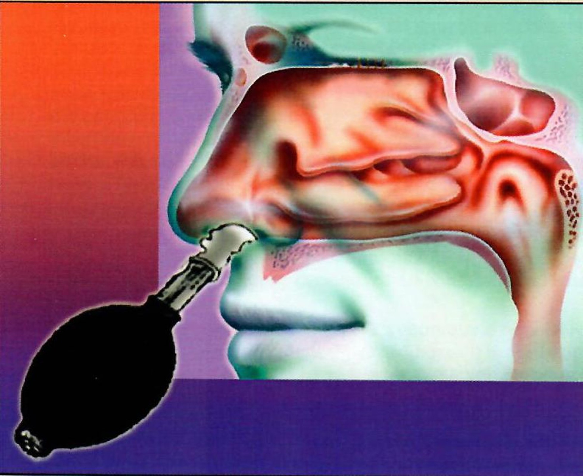 Endonasal "BalloonAssisted" Cranial Adjusting The American Chiropractor DECEMBER 2022