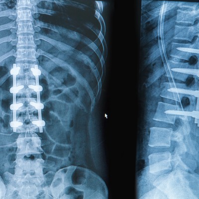 Helping Patients Avoid Another Failed Back Surgery - JANUARY | The American Chiropractor