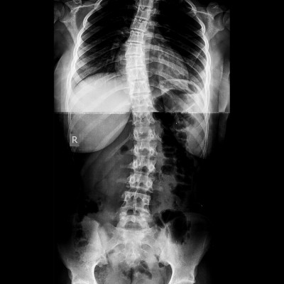 A New Light on Scoliosis - DECEMBER | The American Chiropractor