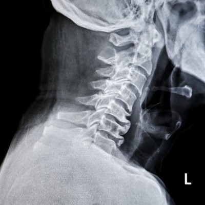 Cervical Anterior Translation - APRIL | The American Chiropractor